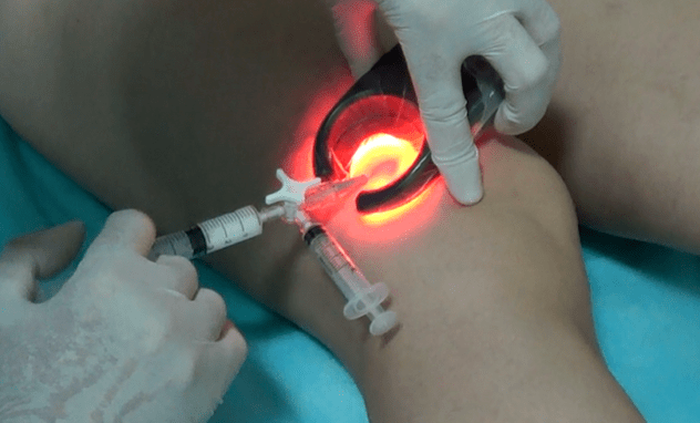 Die Sklerotherapie ist eine wirksame Methode zur Behandlung von Krampfadern an den Beinen